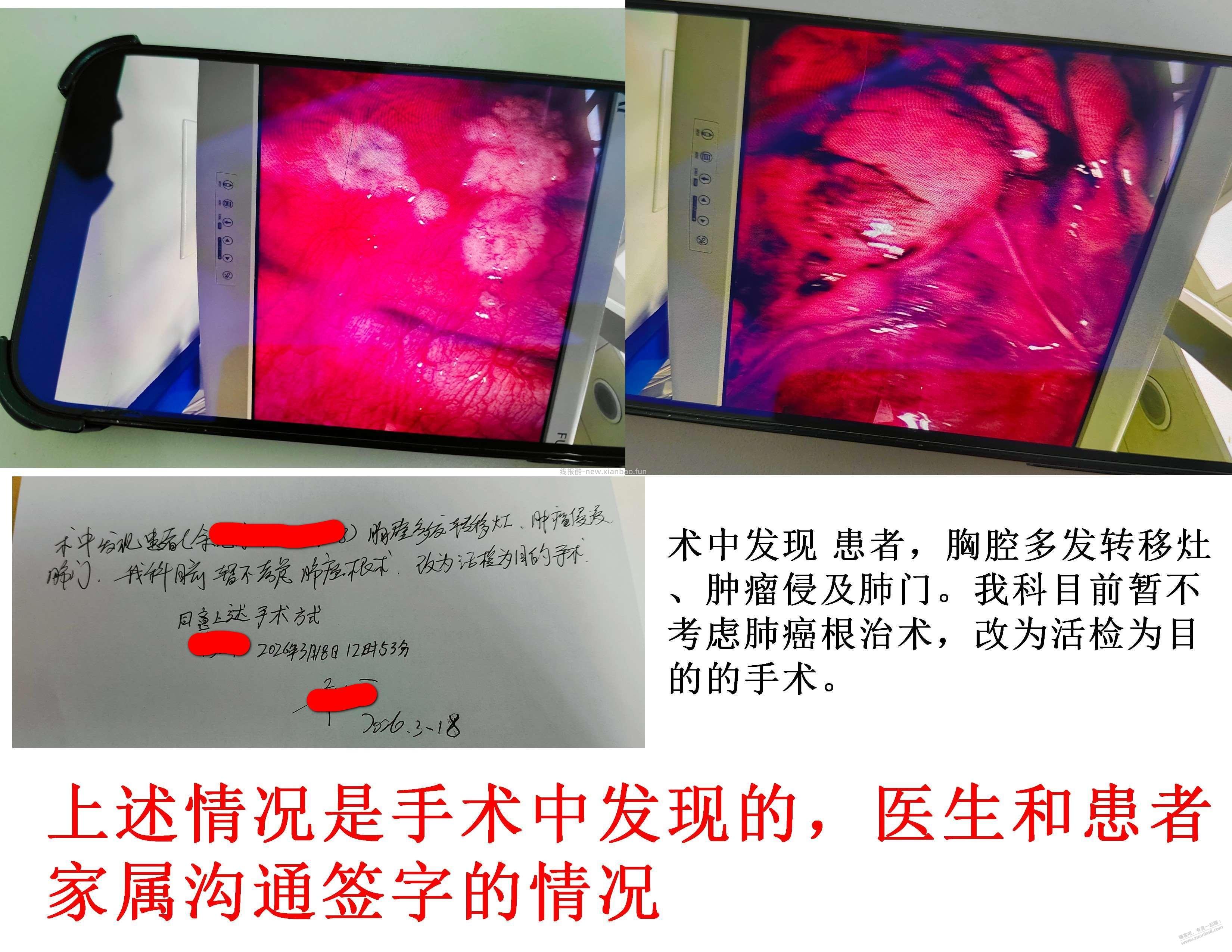 【求助】老母亲肺腺癌晚期，求助吧里大神或者有经历过的吧友 - 线报酷