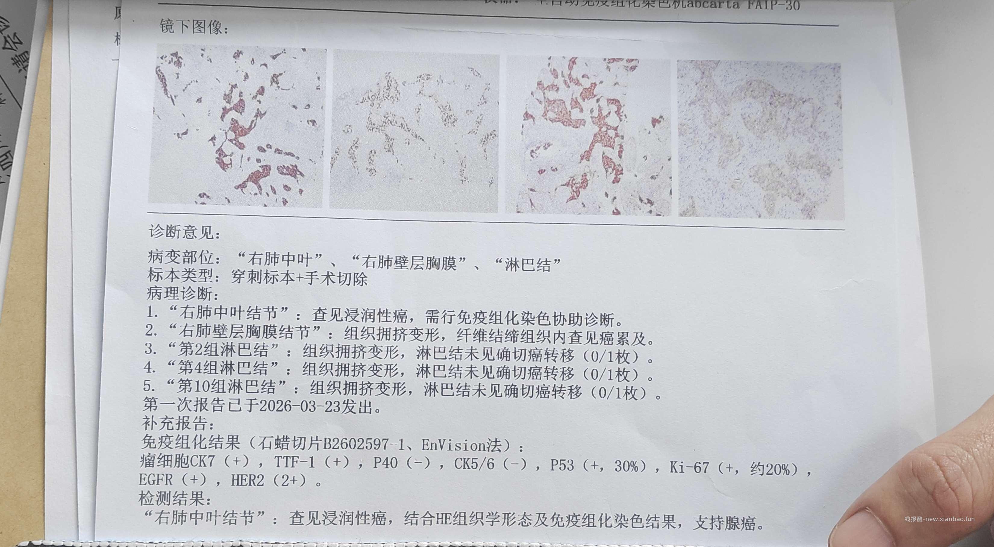 【求助】老母亲肺腺癌晚期，求助吧里大神或者有经历过的吧友 - 线报酷